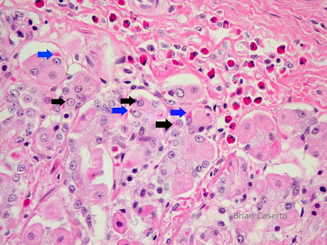 Canine Distemper Virus in 2 Racoons | veterinary pathology